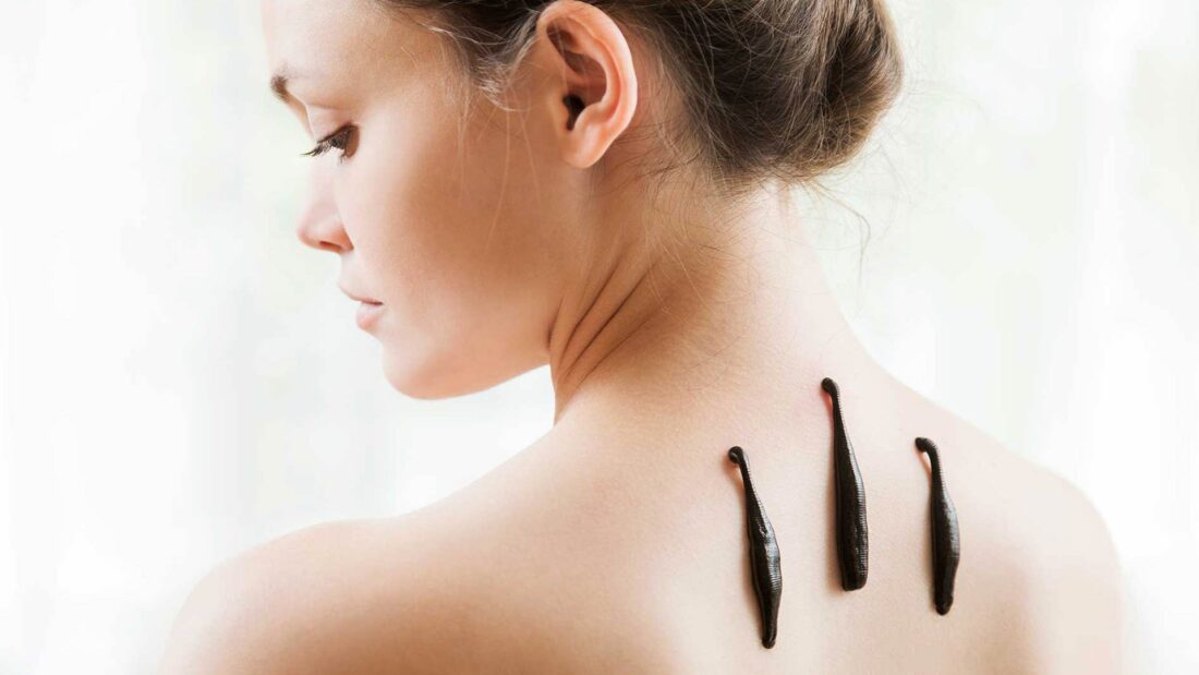 Blutegeltherapie
